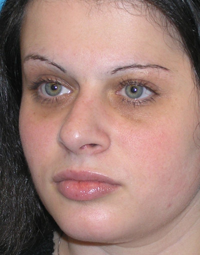 Foundation Rhinoplasty / Crooked Nose Before & After Gallery - Patient 118527 - Image 4