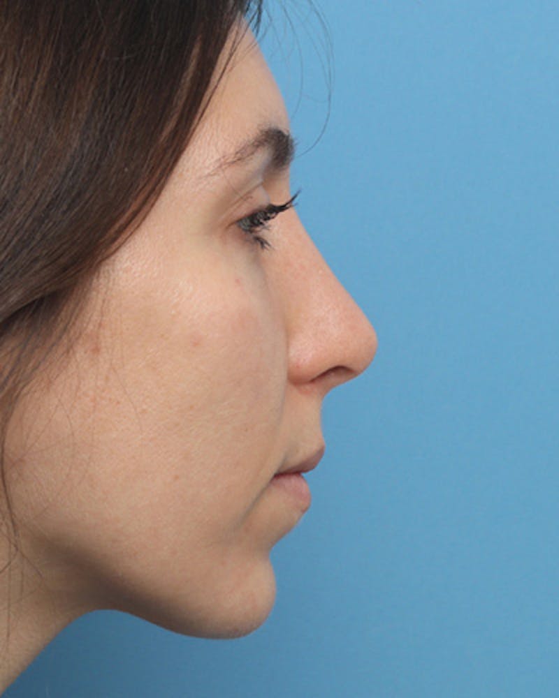 Rhinoplasty Before & After Gallery - Patient 376775 - Image 2