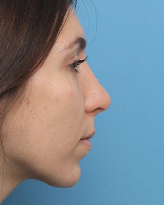 Favorite Rhinoplasty Before & After Gallery - Patient 106536 - Image 2