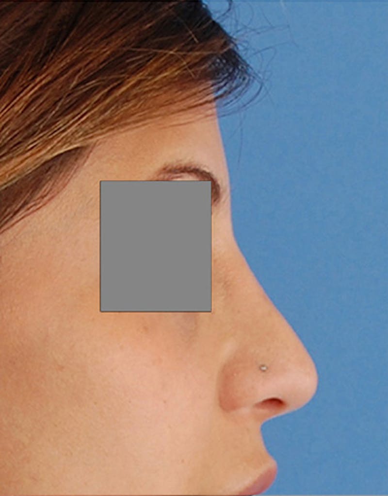 Revision Rhinoplasty Before & After Gallery - Patient 187105 - Image 2