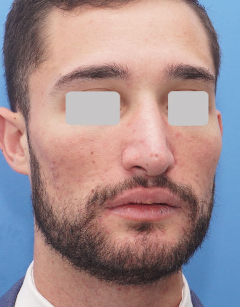 Male Rhinoplasty Before & After Gallery - Patient 380813 - Image 4