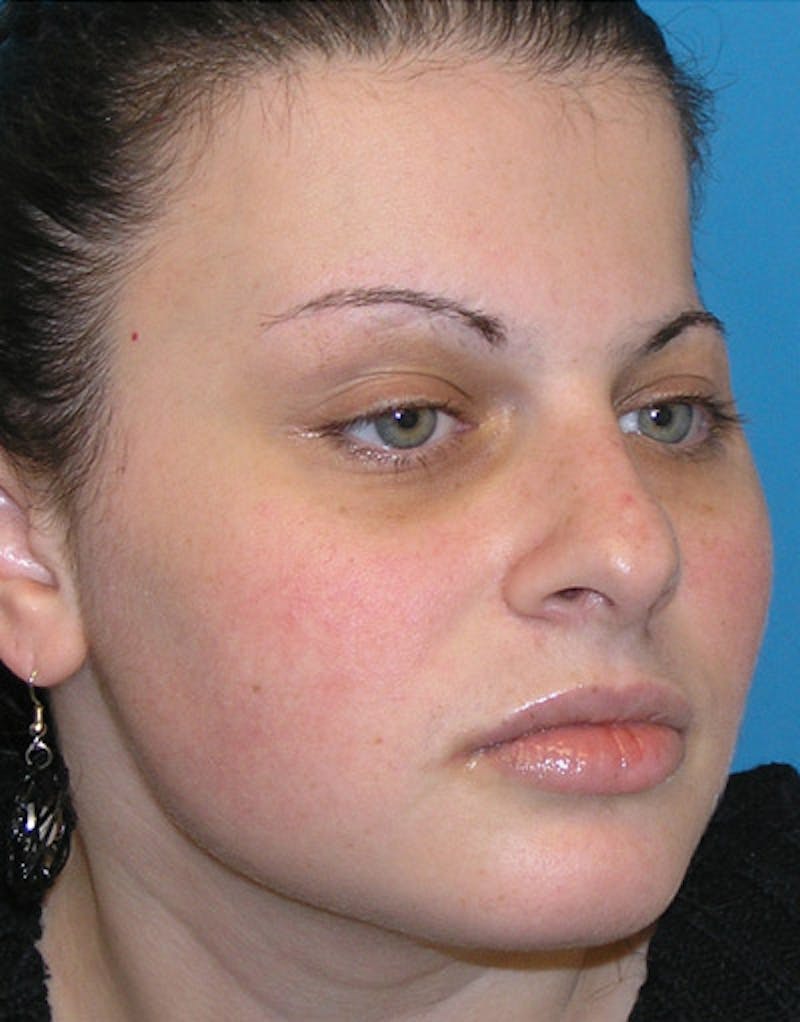 Foundation Rhinoplasty / Crooked Nose Before & After Gallery - Patient 118527 - Image 5