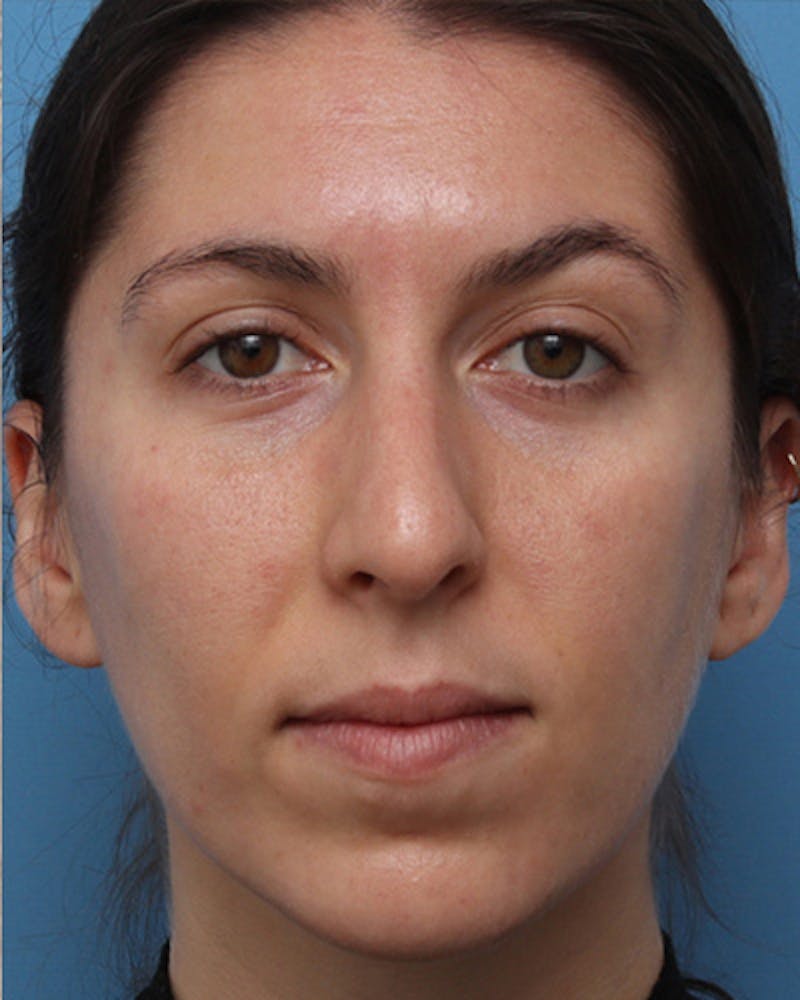 Rhinoplasty Before & After Gallery - Patient 376775 - Image 3