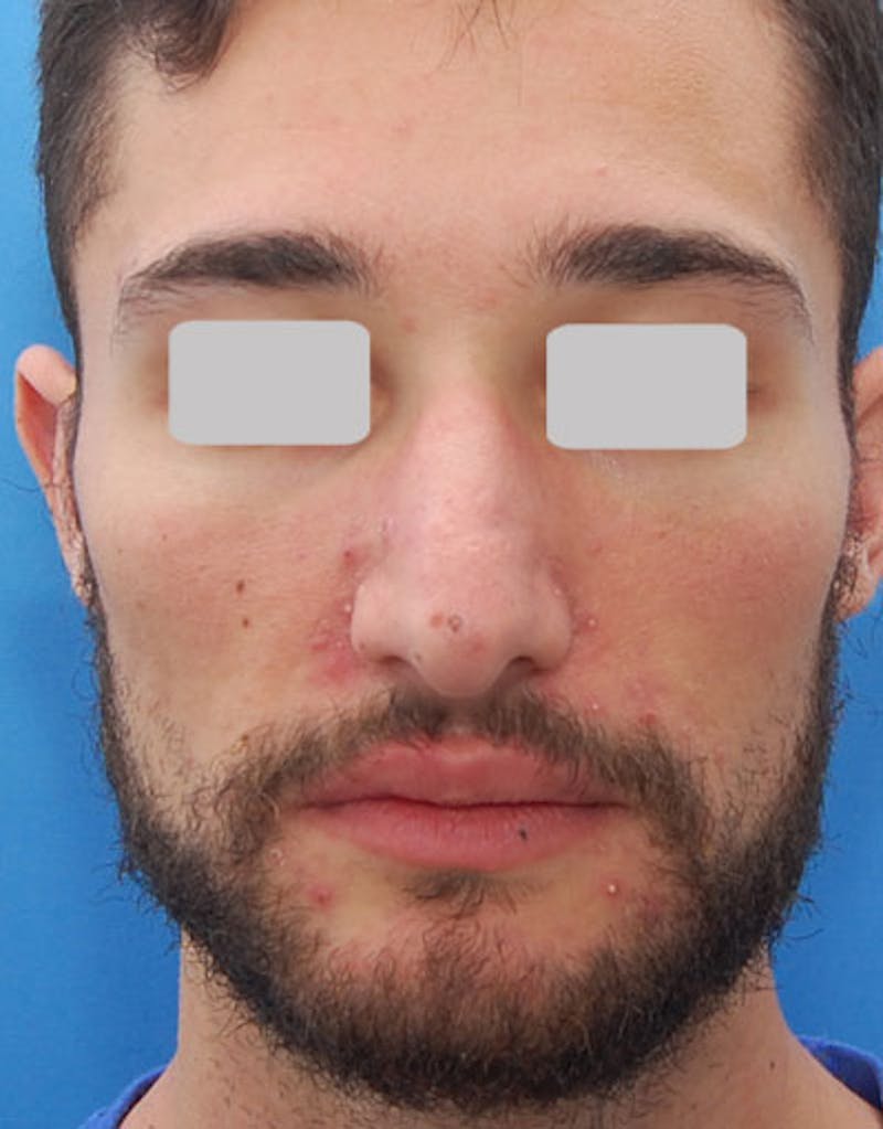 Male Rhinoplasty Before & After Gallery - Patient 380813 - Image 5
