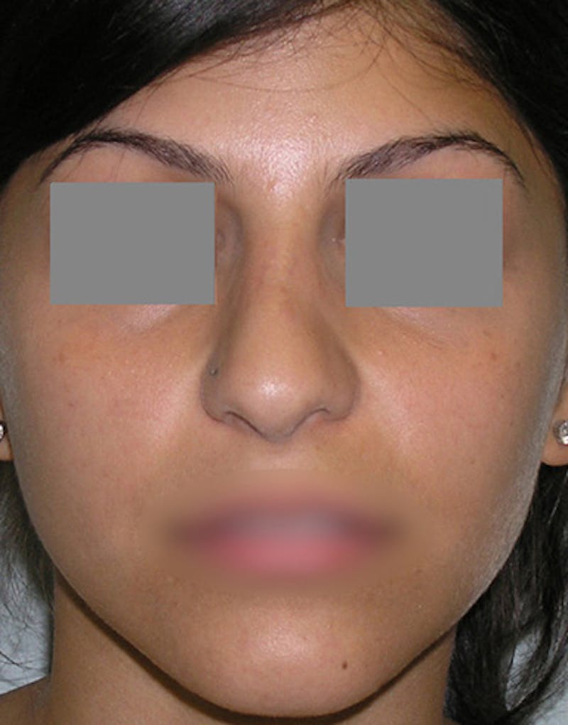 Revision Rhinoplasty Before & After Gallery - Patient 187105 - Image 3