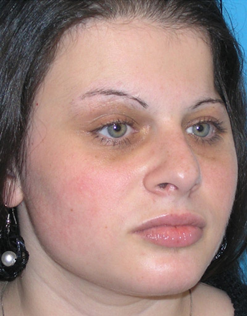 Foundation Rhinoplasty / Crooked Nose Before & After Gallery - Patient 118527 - Image 6