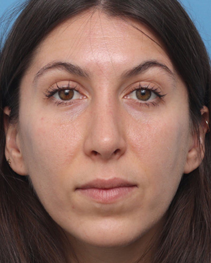 Rhinoplasty Before & After Gallery - Patient 376775 - Image 4