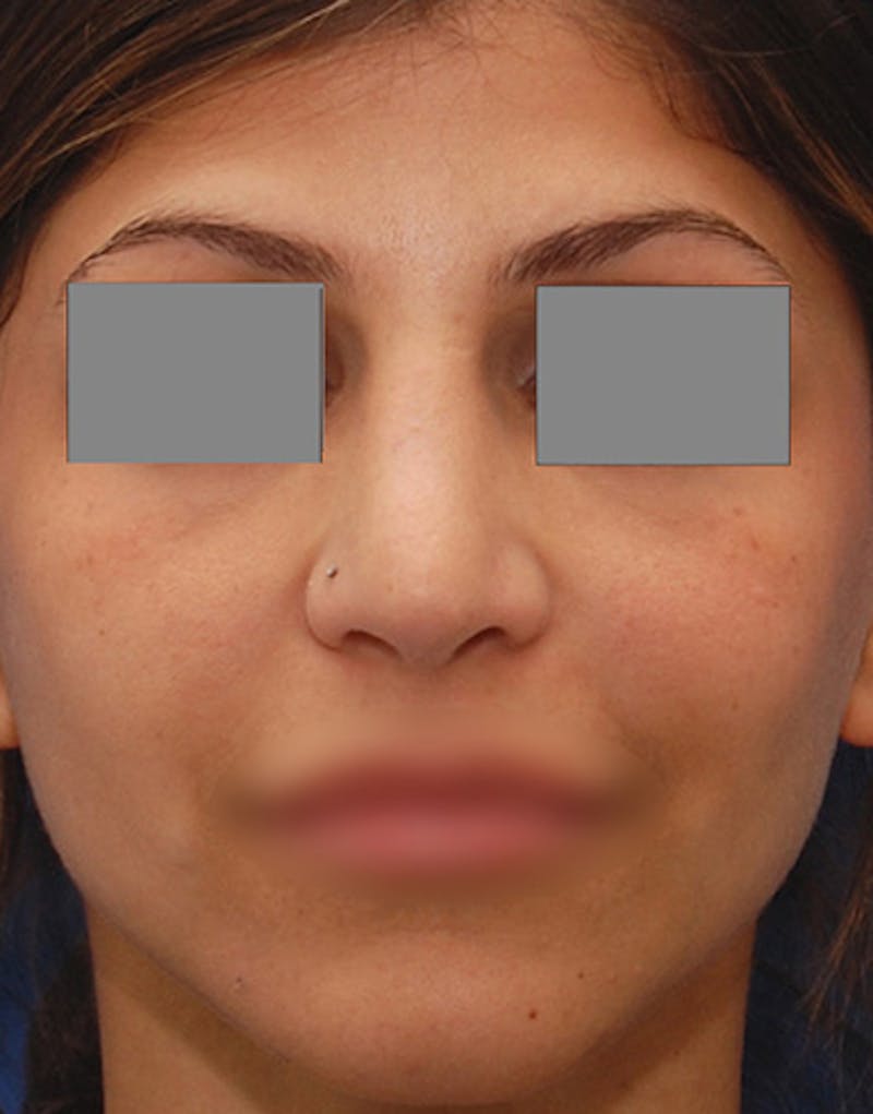 Revision Rhinoplasty Before & After Gallery - Patient 187105 - Image 4