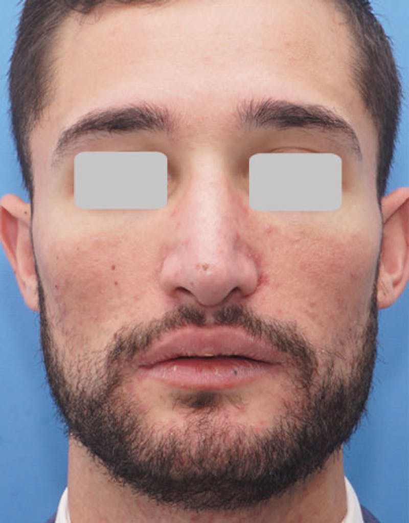 Male Rhinoplasty Before & After Gallery - Patient 380813 - Image 6