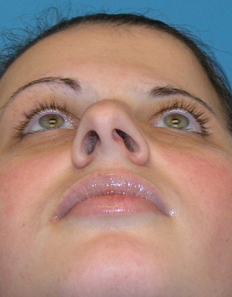 Foundation Rhinoplasty / Crooked Nose Before & After Gallery - Patient 118527 - Image 7