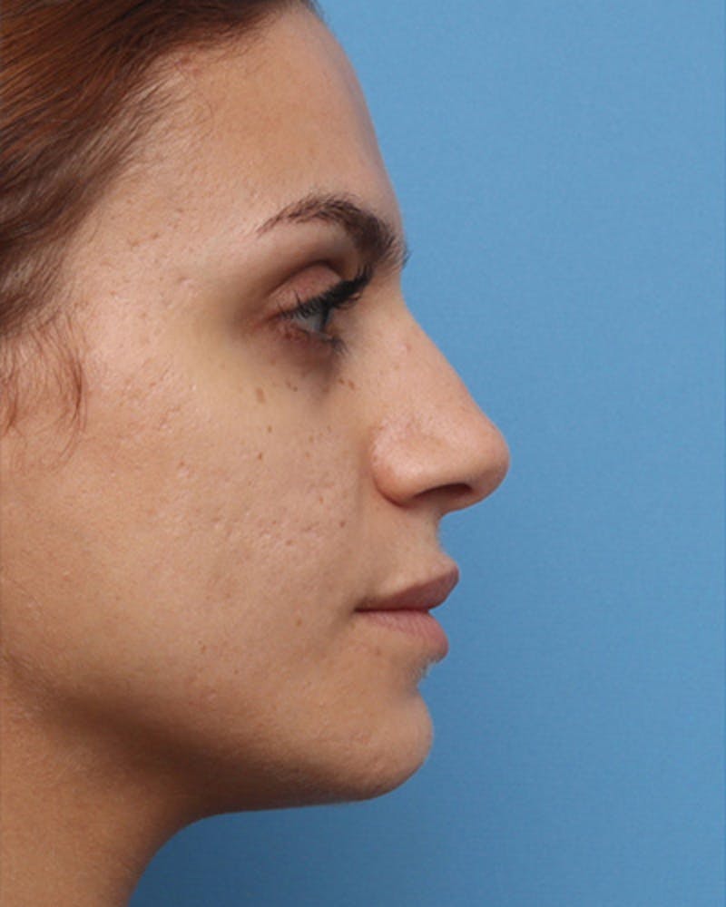 Rhinoplasty Before & After Gallery - Patient 224019 - Image 1
