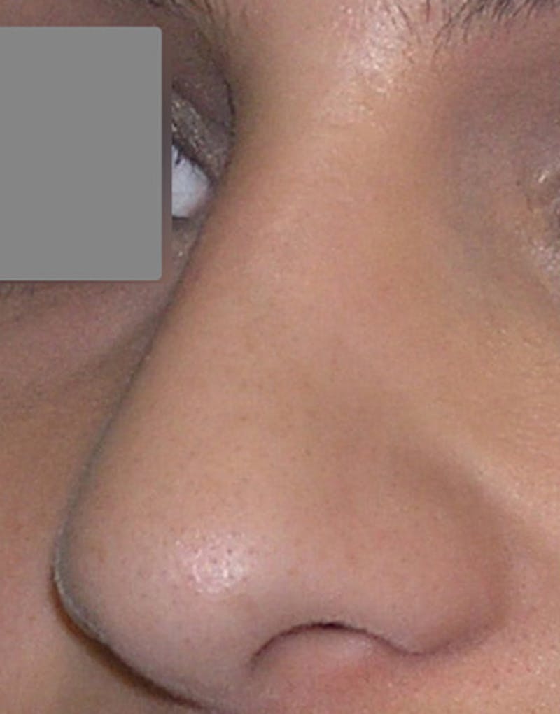 Revision Rhinoplasty Before & After Gallery - Patient 187105 - Image 5