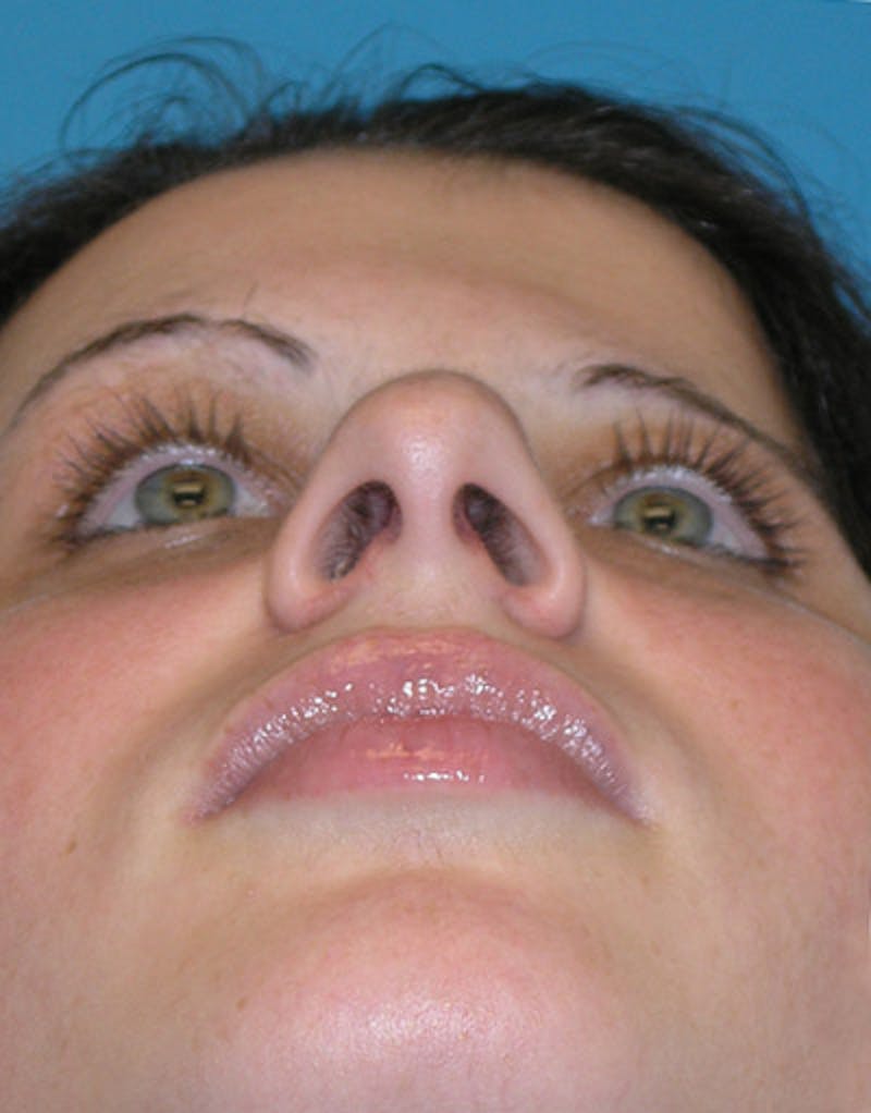 Foundation Rhinoplasty / Crooked Nose Before & After Gallery - Patient 118527 - Image 8