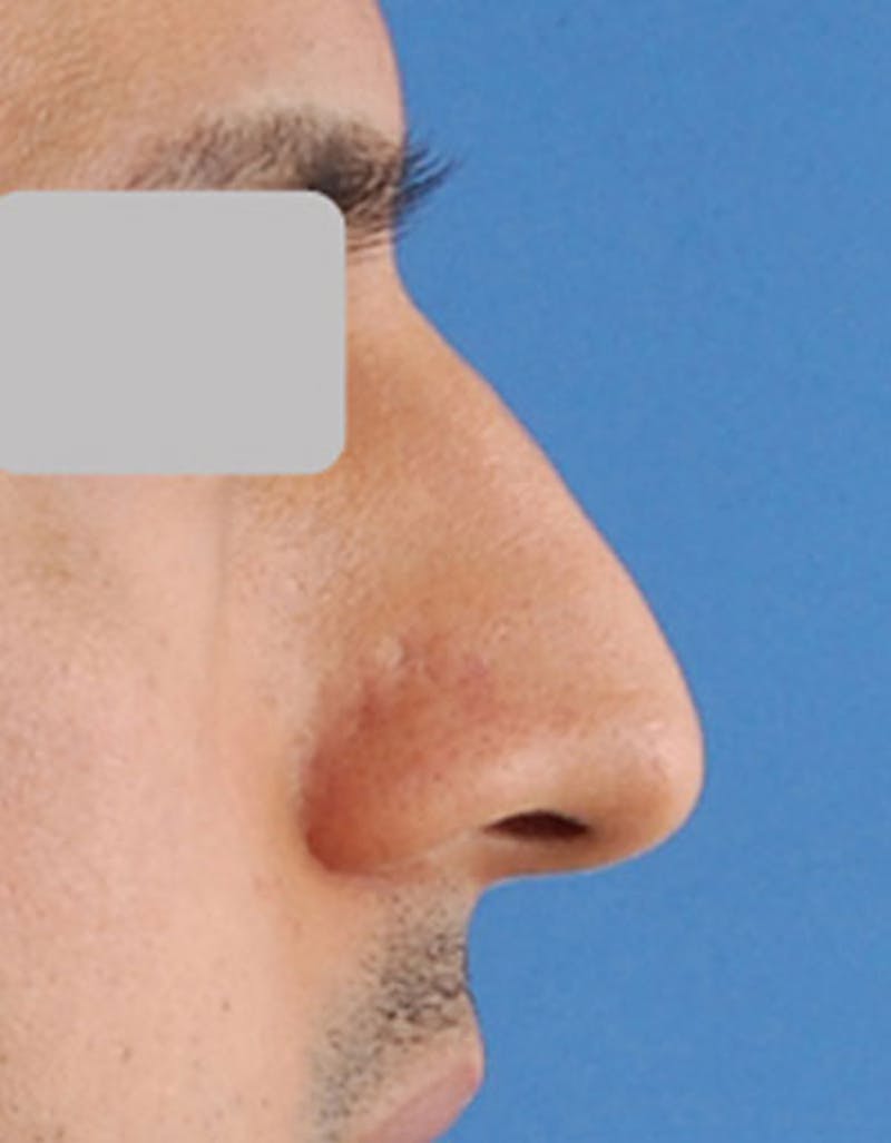 Patient AfxVcRvwTq64g8-xNX1_4Q - Male Rhinoplasty Before & After Photos