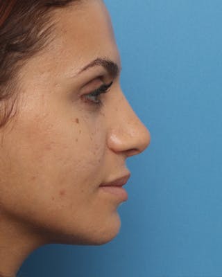 Favorite Ethnic Rhinoplasty Before & After Gallery - Patient 169969 - Image 2