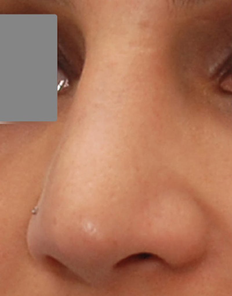 Revision Rhinoplasty Before & After Gallery - Patient 187105 - Image 6