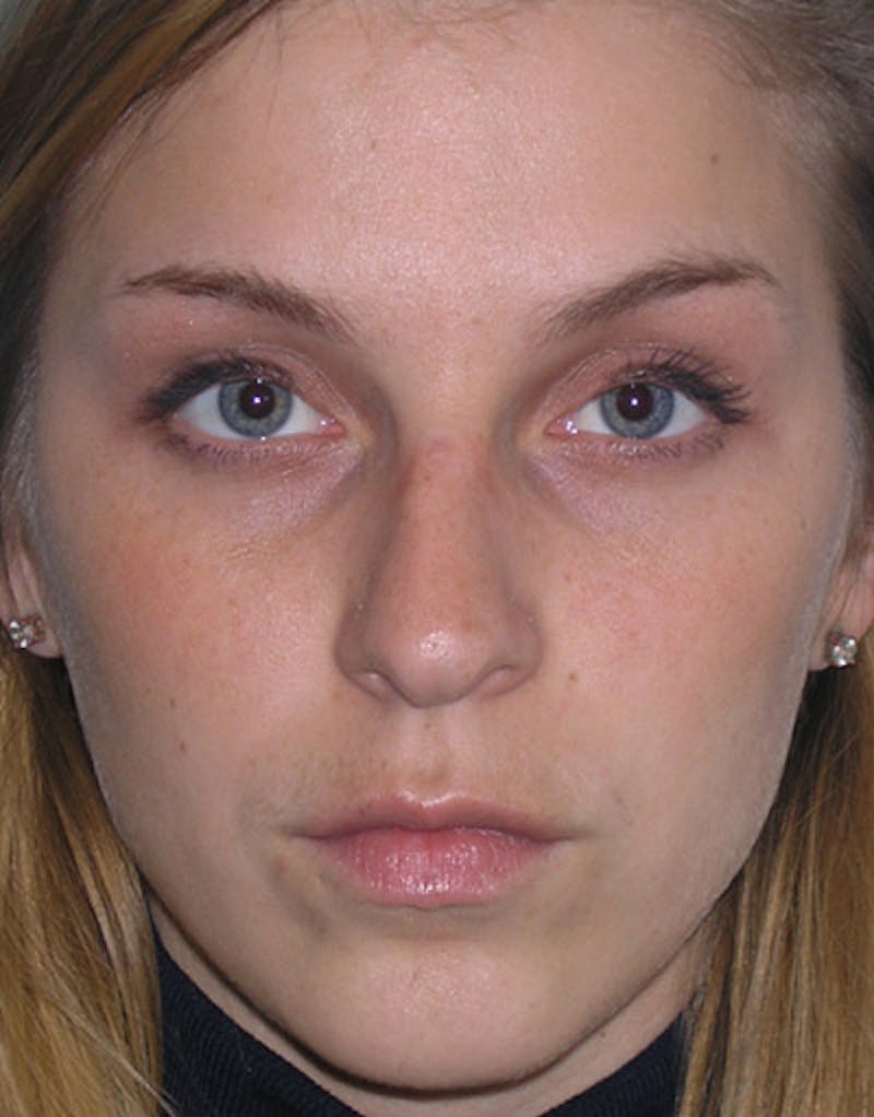 Patient HZygTMOMRt-_dE68Dszczg - Foundation Rhinoplasty Before & After Photos