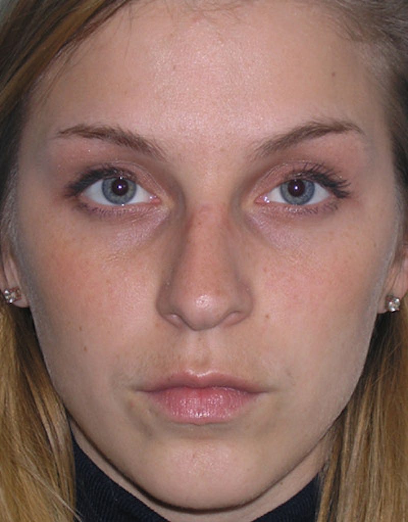 Foundation Rhinoplasty / Crooked Nose Before & After Gallery - Patient 161556 - Image 1