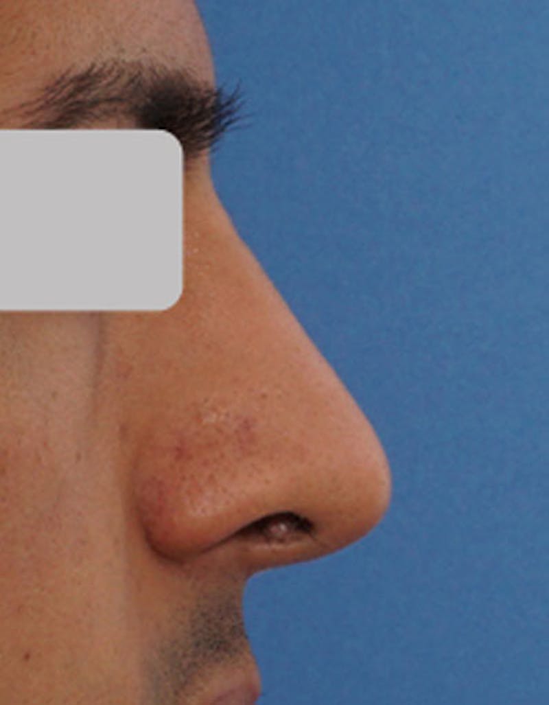 Male Rhinoplasty Before & After Gallery - Patient 281942 - Image 2