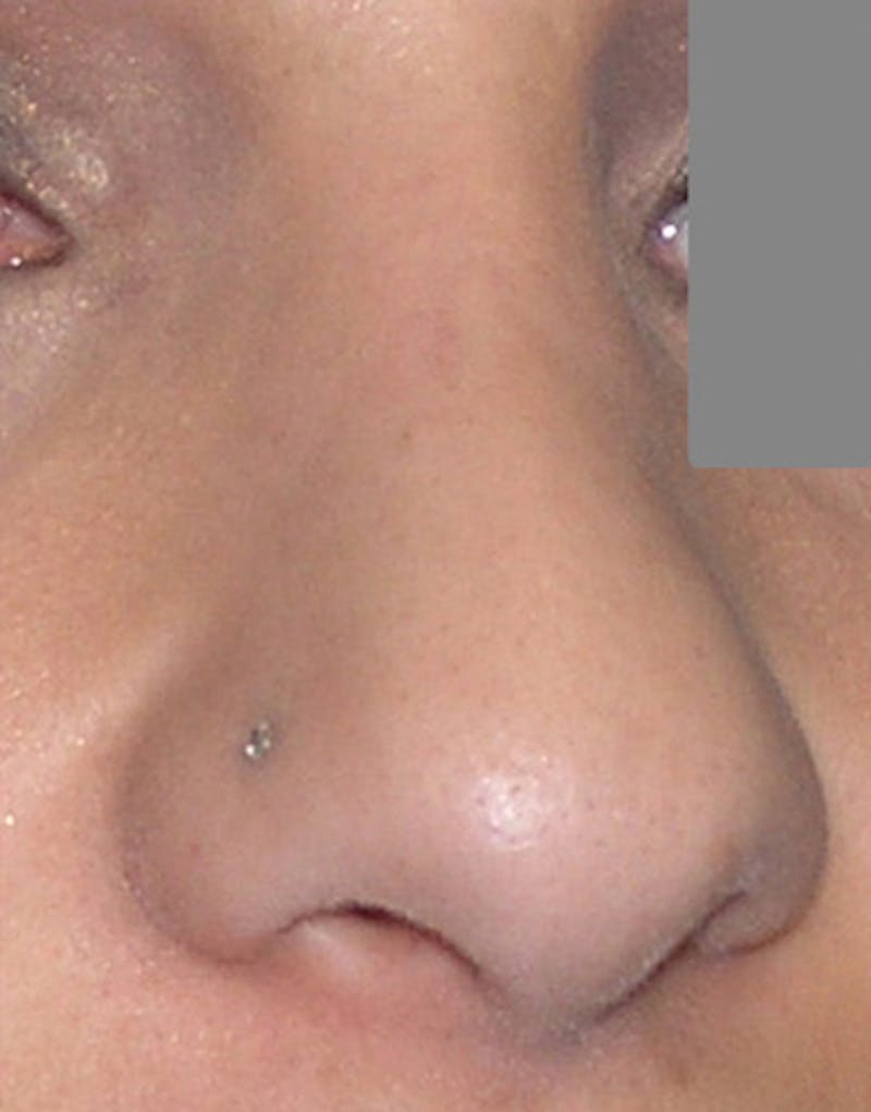Revision Rhinoplasty Before & After Gallery - Patient 187105 - Image 7