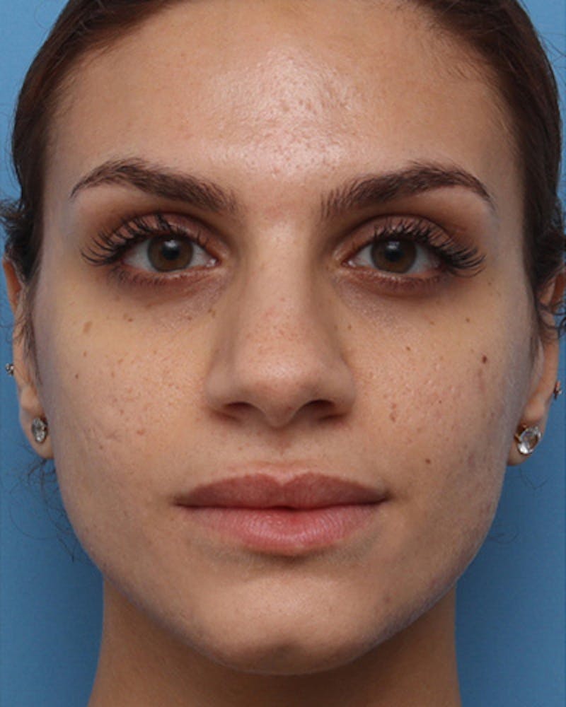 Rhinoplasty Before & After Gallery - Patient 224019 - Image 5