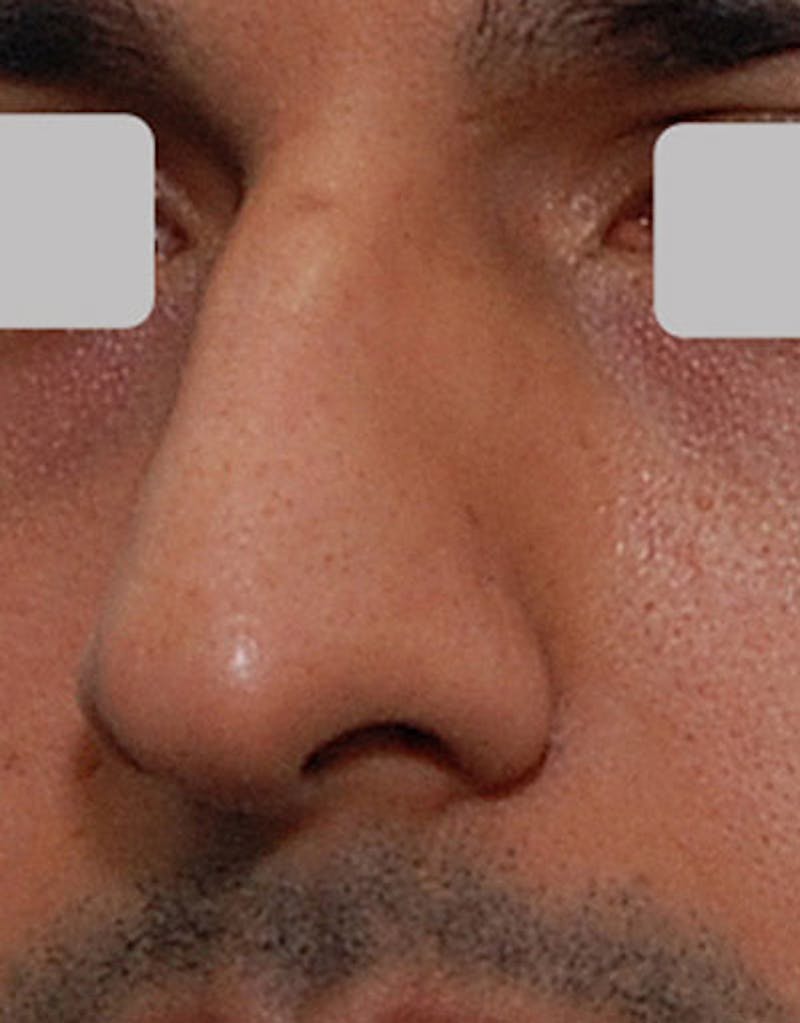 Male Rhinoplasty Before & After Gallery - Patient 281942 - Image 3
