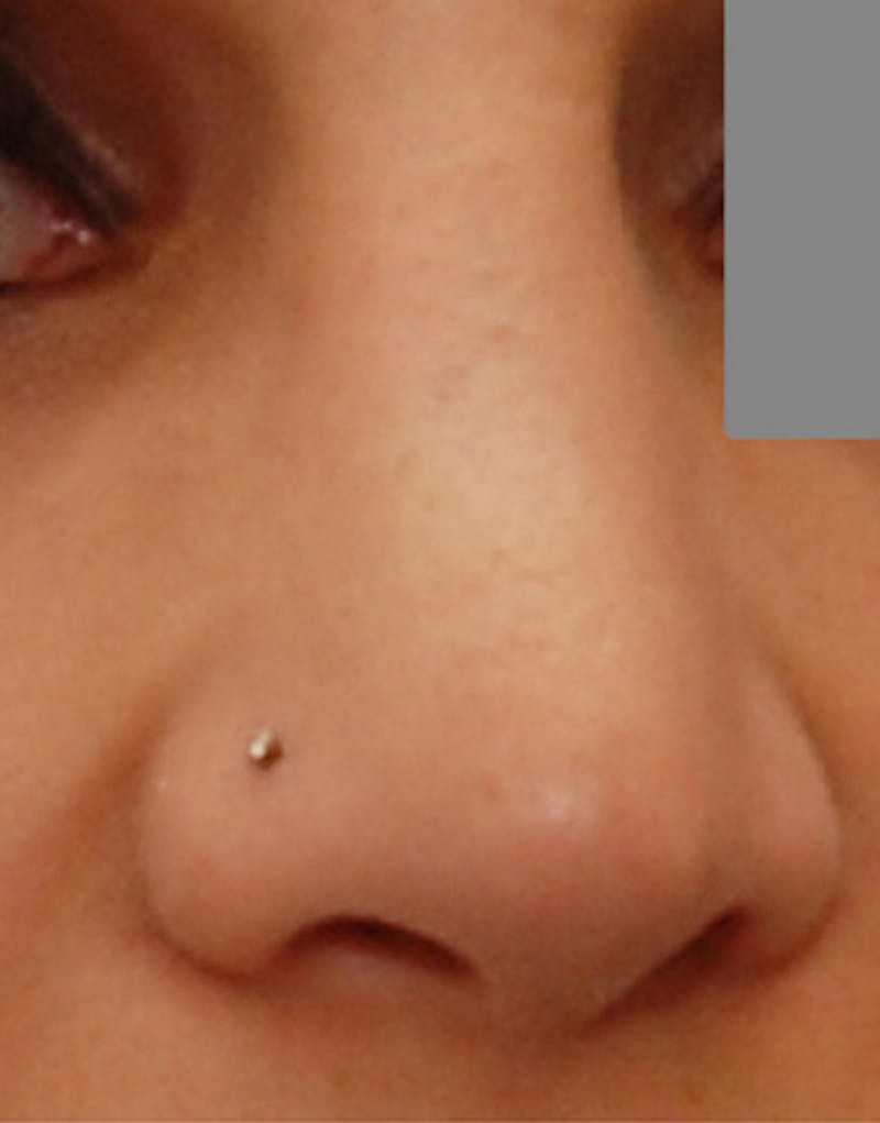 Revision Rhinoplasty Before & After Gallery - Patient 187105 - Image 8