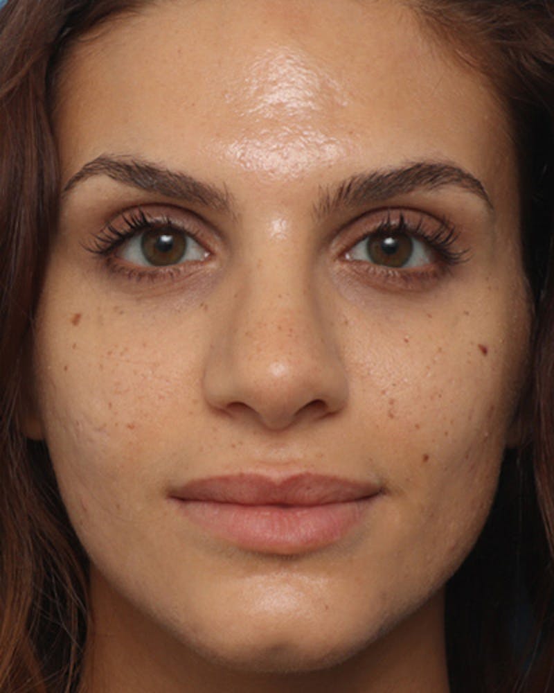 Rhinoplasty  Before & After Gallery - Patient 245896 - Image 6