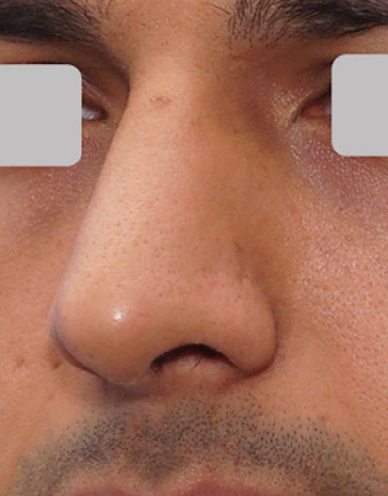 Male Rhinoplasty Before & After Gallery - Patient 281942 - Image 4
