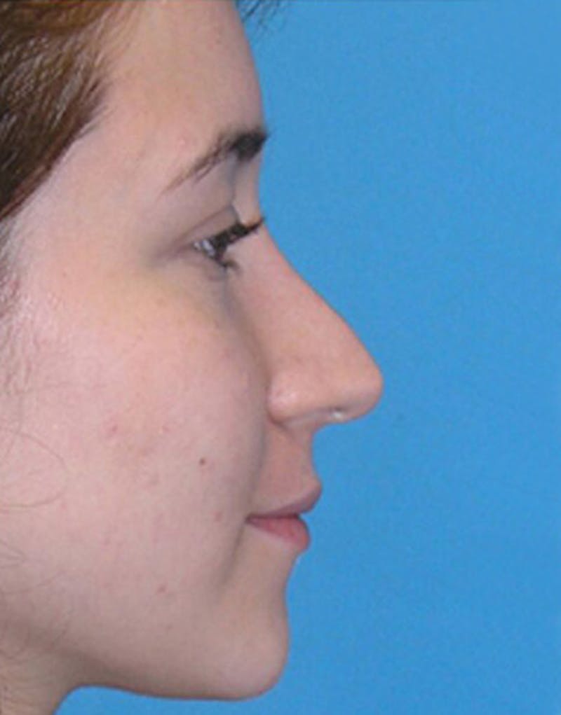 Patient PsCyfk1sQTKZJZ4fNyhV5A - Revision Rhinoplasty Before & After Photos