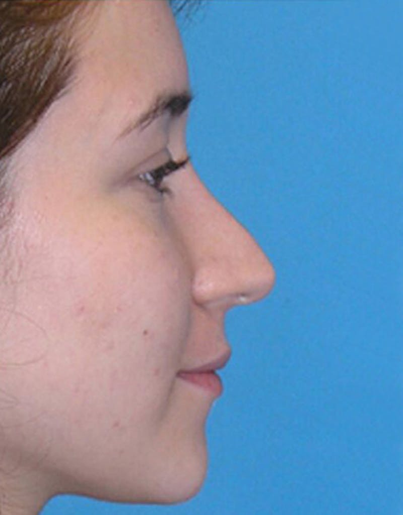 Revision Rhinoplasty Before & After Gallery - Patient 404614 - Image 1