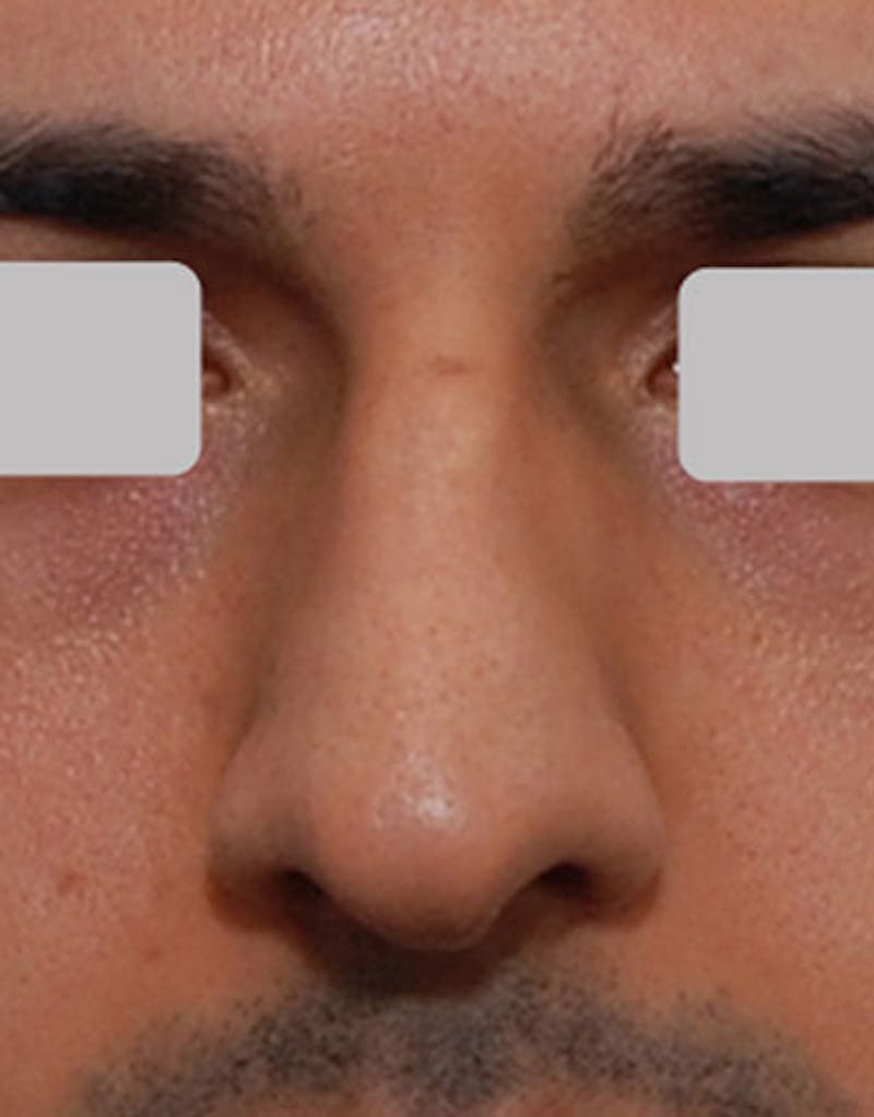 Male Rhinoplasty Before & After Gallery - Patient 281942 - Image 5