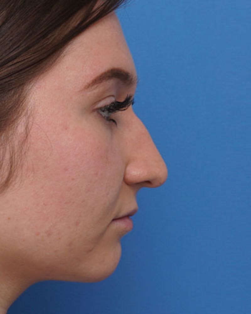 Rhinoplasty Before & After Gallery - Patient 227683 - Image 1
