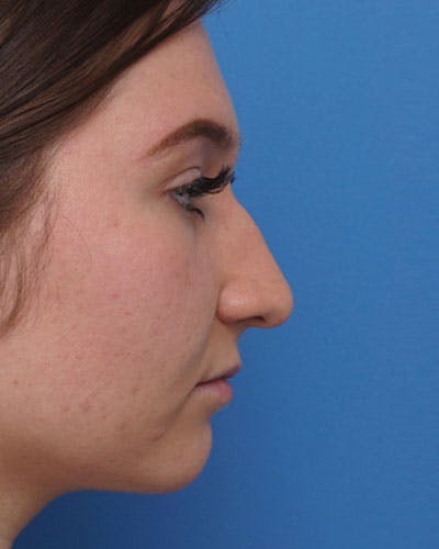 Rhinoplasty Before & After Gallery - Patient 180988 - Image 1