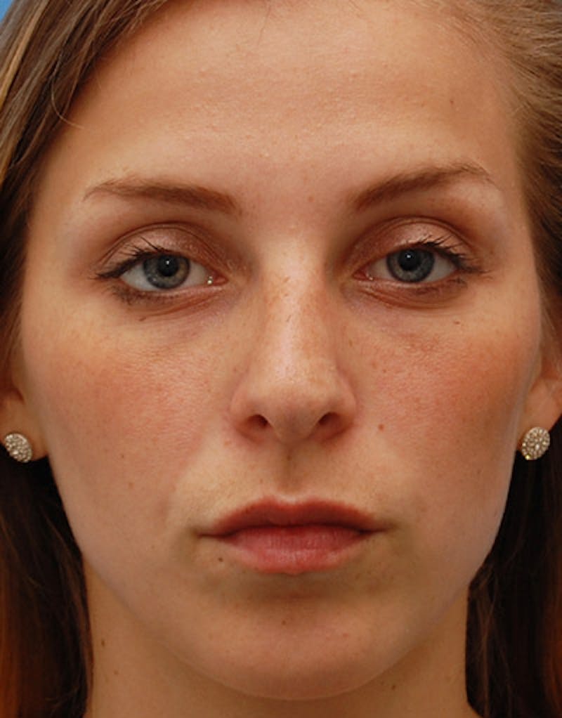 Foundation Rhinoplasty / Crooked Nose Before & After Gallery - Patient 161556 - Image 2