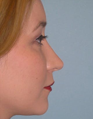 Favorite Revision Rhinoplasty Before & After Gallery - Patient 896541 - Image 2