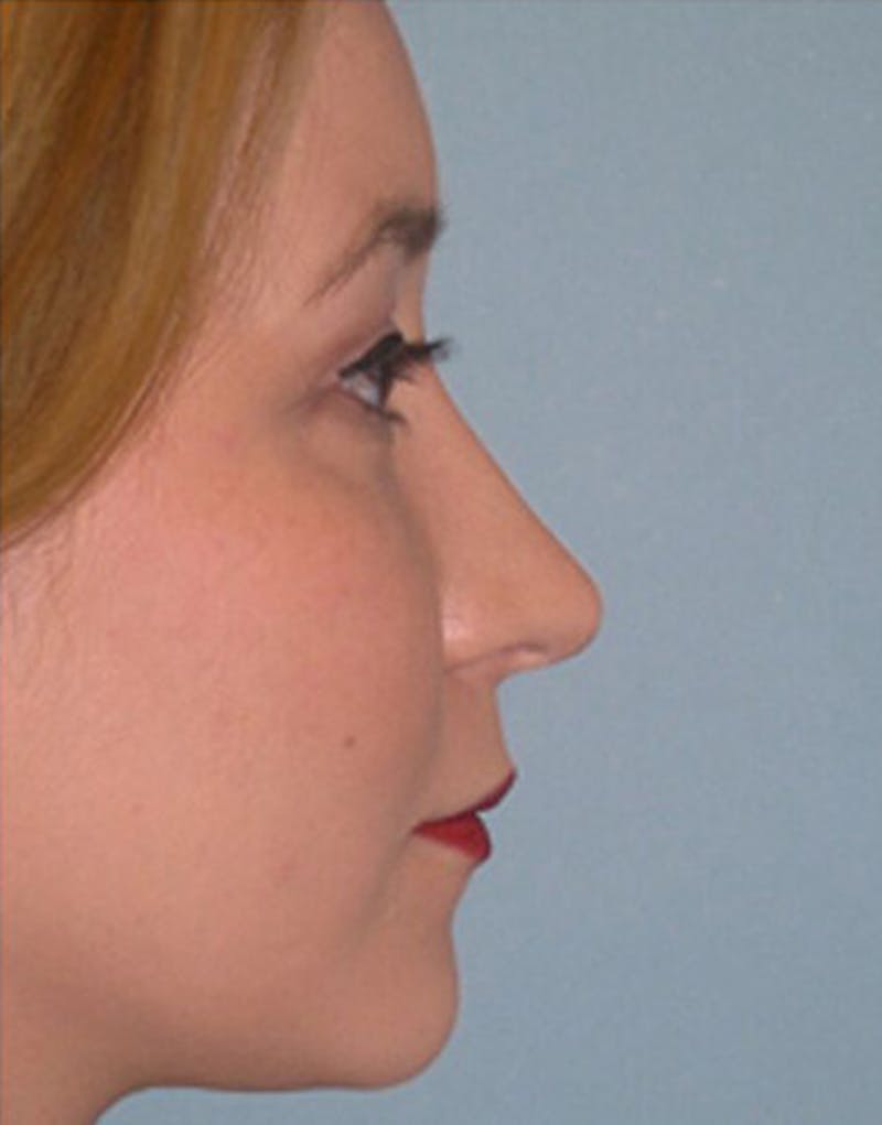 Revision Rhinoplasty Before & After Gallery - Patient 404614 - Image 2