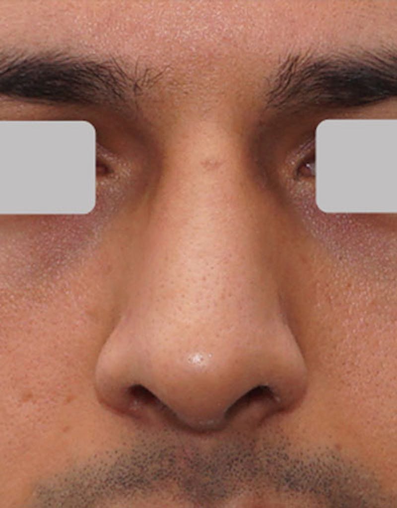 Male Rhinoplasty Before & After Gallery - Patient 281942 - Image 6