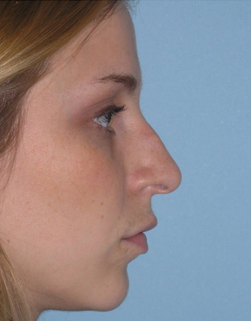 Foundation Rhinoplasty / Crooked Nose Before & After Gallery - Patient 161556 - Image 3