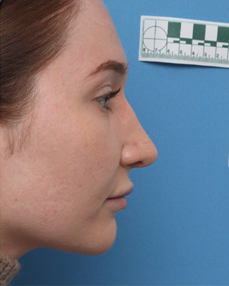 Rhinoplasty Before & After Gallery - Patient 227683 - Image 2