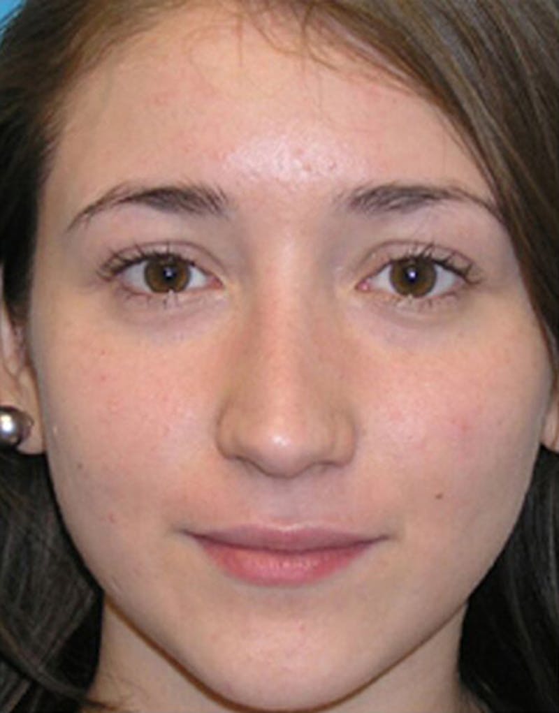 Revision Rhinoplasty Before & After Gallery - Patient 404614 - Image 3