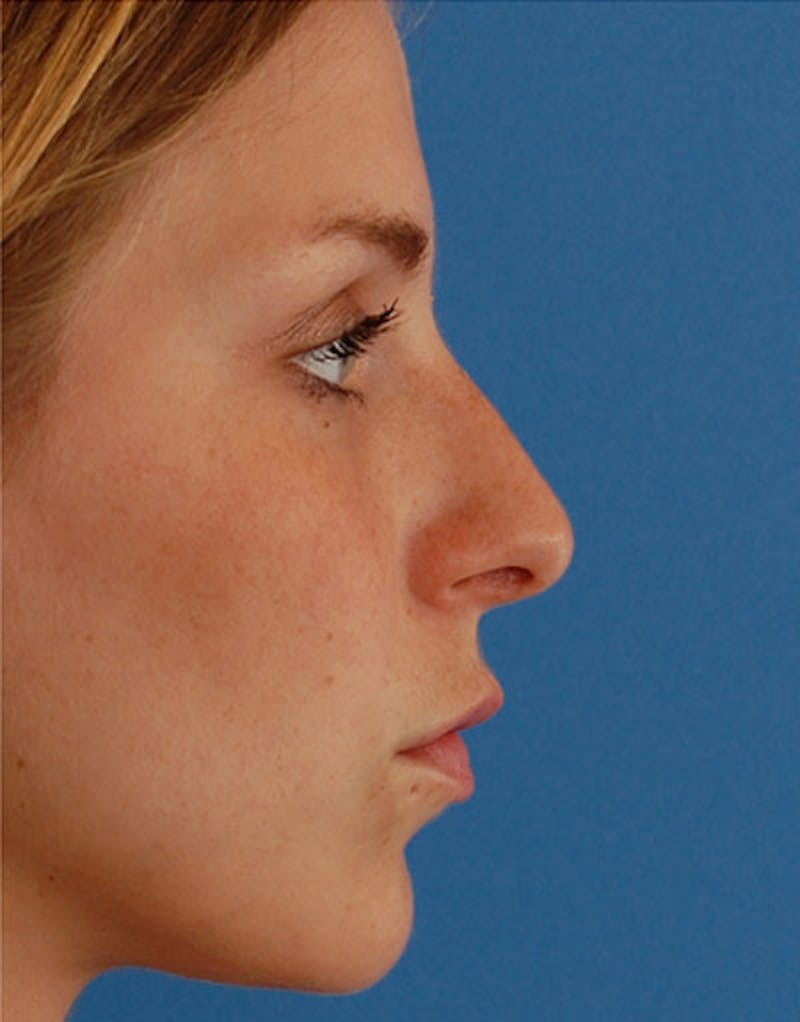 Foundation Rhinoplasty / Crooked Nose Before & After Gallery - Patient 161556 - Image 4