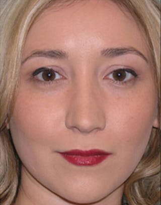 Favorite Revision Rhinoplasty Before & After Gallery - Patient 896541 - Image 4