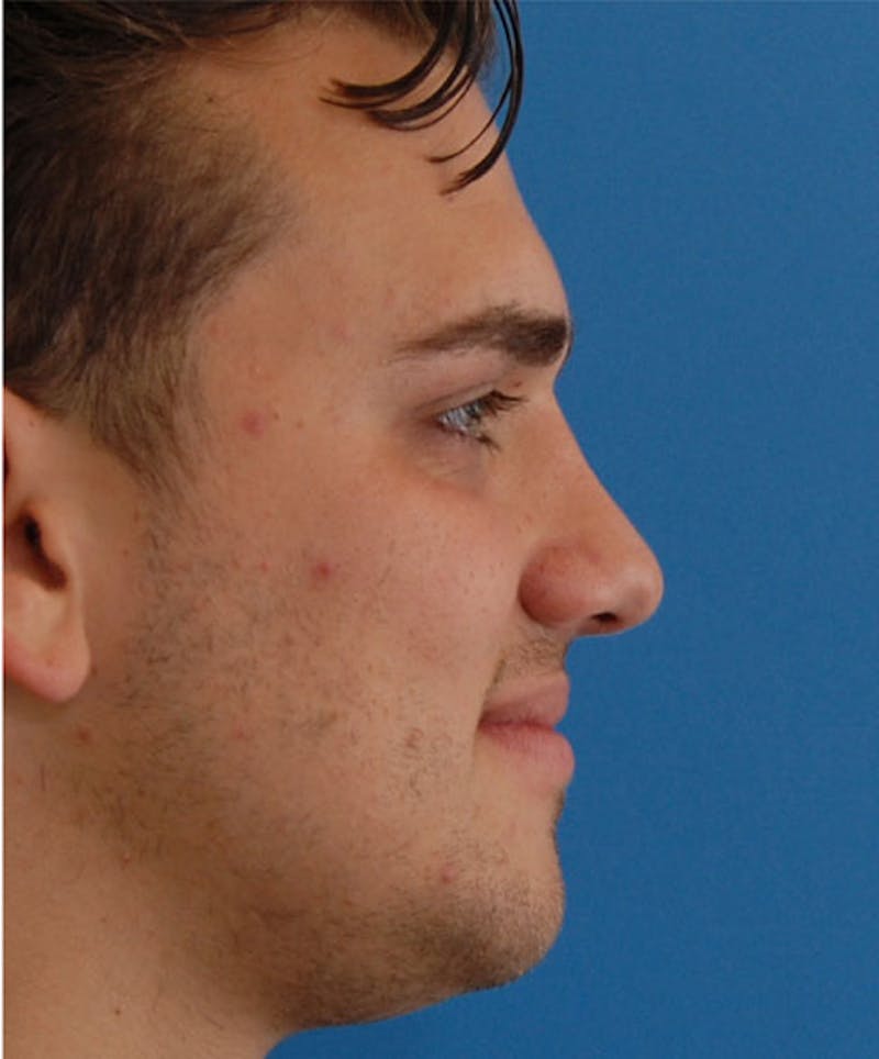 Male Rhinoplasty Before & After Gallery - Patient 239463 - Image 2