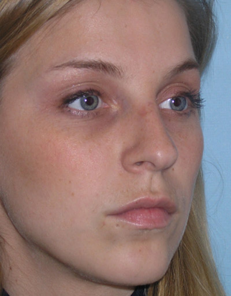 Foundation Rhinoplasty / Crooked Nose Before & After Gallery - Patient 161556 - Image 5