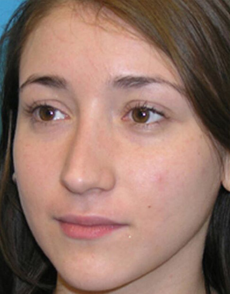 Revision Rhinoplasty Before & After Gallery - Patient 404614 - Image 5