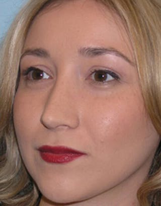 Favorite Revision Rhinoplasty Before & After Gallery - Patient 896541 - Image 6