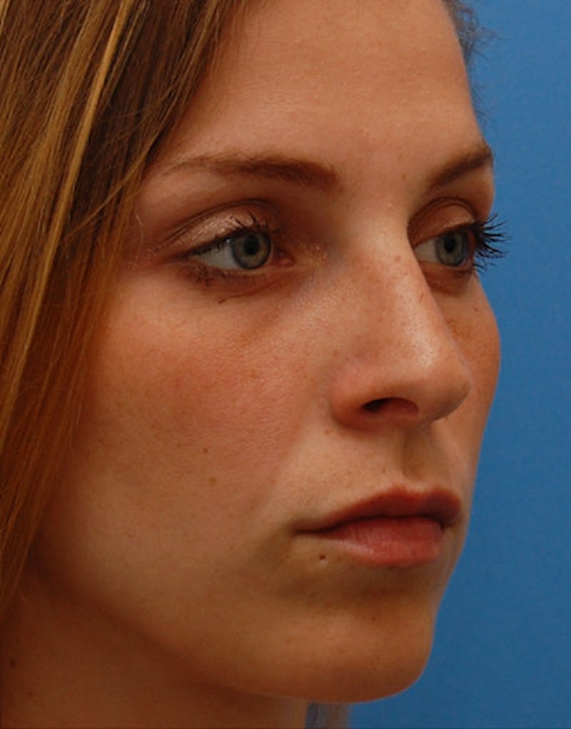 Foundation Rhinoplasty / Crooked Nose Before & After Gallery - Patient 161556 - Image 6