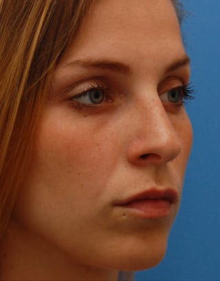 Favorite Foundation Rhinoplasty / Crooked Nose Before & After Gallery - Patient 294496 - Image 6