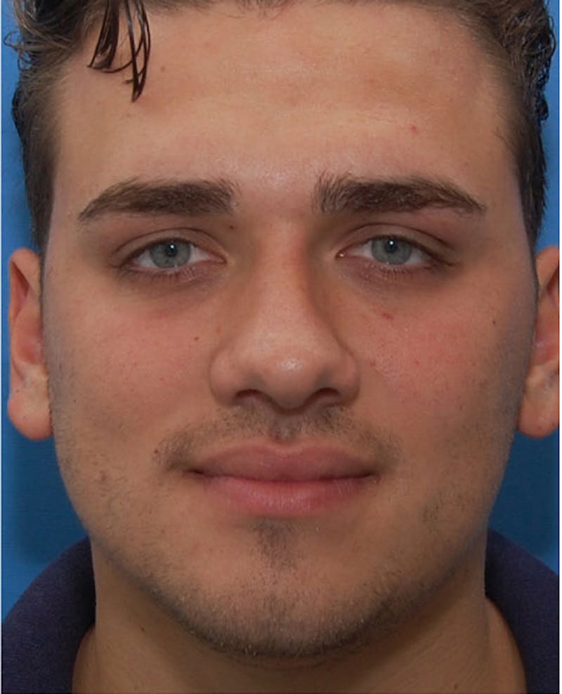 Male Rhinoplasty Before & After Gallery - Patient 239463 - Image 4
